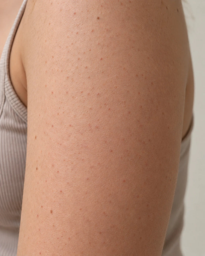 After 8 weeks: the same upper arm showing a smoother-looking surface and fewer prominent bumps while maintaining natural skin texture.