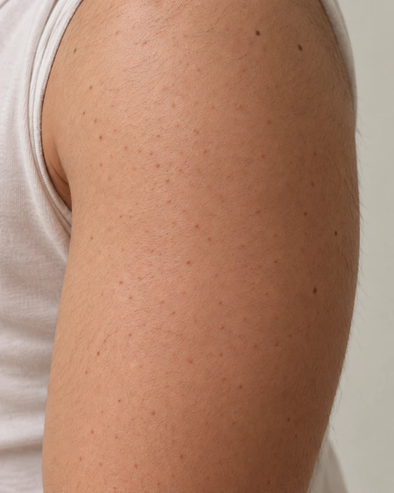 After 6 weeks: the same upper arm with visibly reduced roughness while natural follicles and body hair remain unchanged.