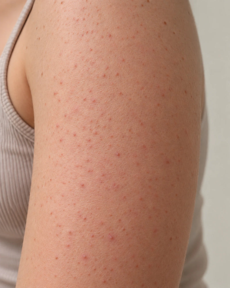 After 12 weeks: the same upper arm showing smoother-looking follicles and less visible redness, with normal colour variation preserved.