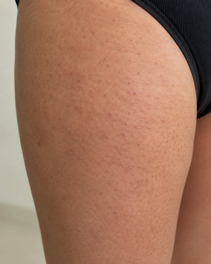 Before: close-up ofan illustrative model's thigh showing small raised follicular bumps and patchyrough skin texture.