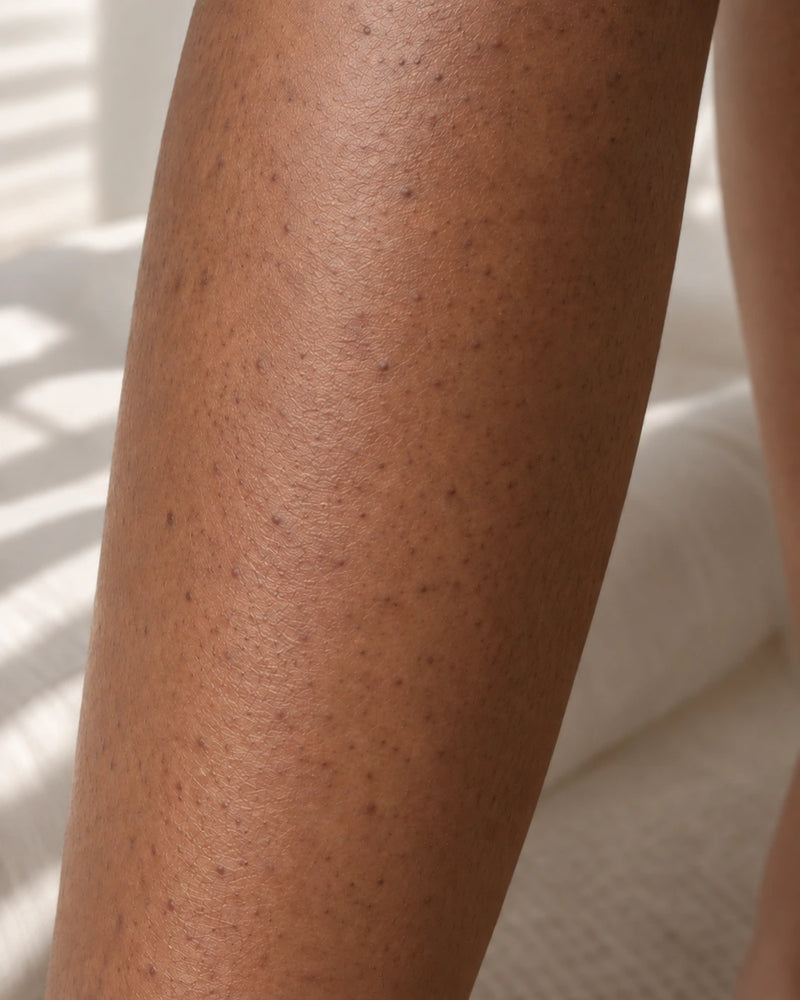 After 12 weeks: the same leg with visibly smoother texture and less prominent follicular marks, without altering the model's natural skin tone.