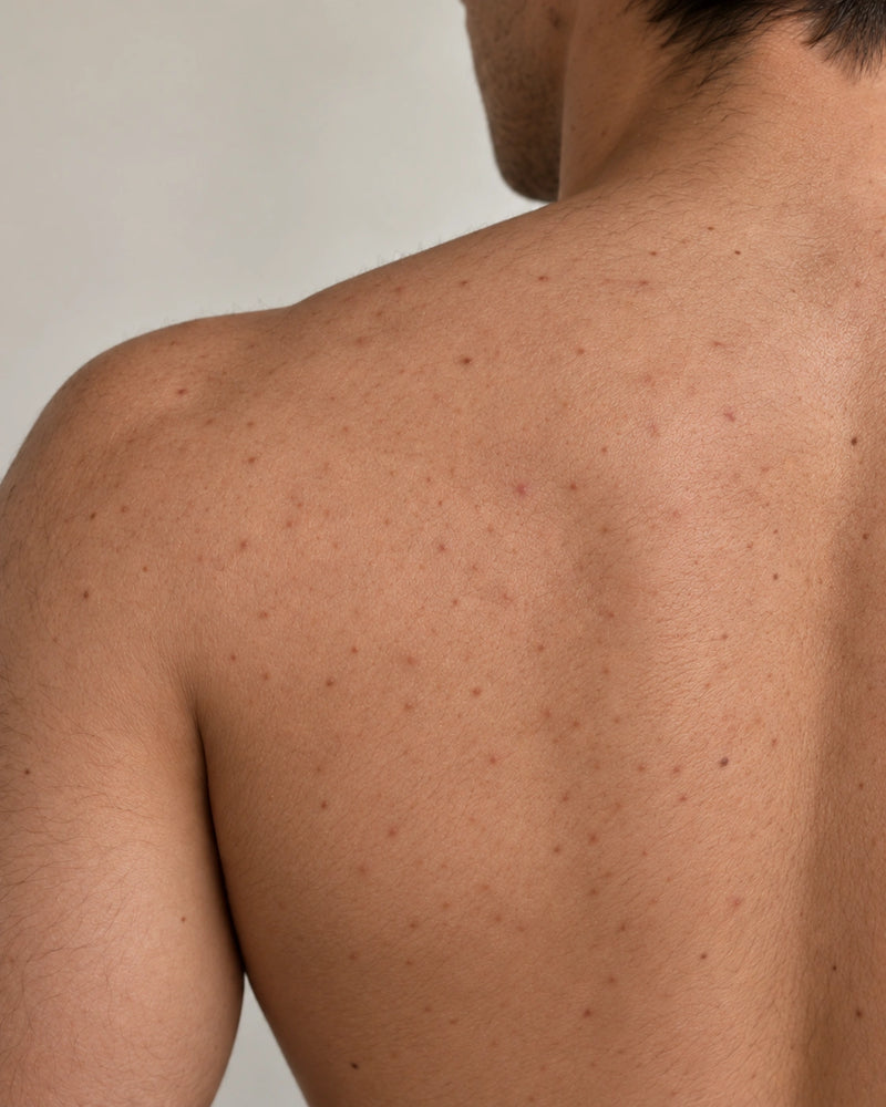 After 12 weeks: the same upper back and shoulder showing smoother-looking texture and fewer raised bumps while natural marks, pores and body hair remain visible.