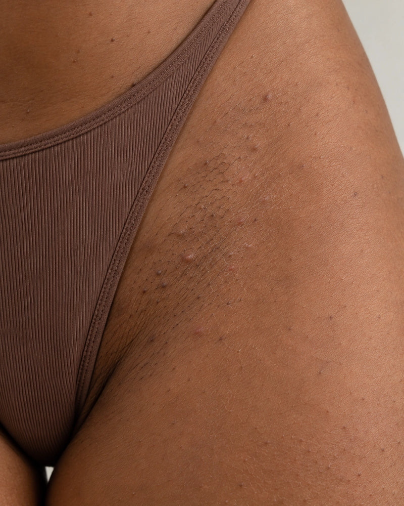 Before: close-up of an adult illustrative model's outer bikini-line skin showing dryness, rough follicular texture and natural body hair.