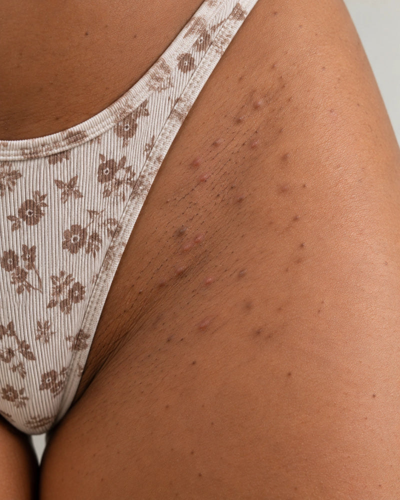 Before: close-up of an adult illustrative model's outer bikini line showing visible follicular bumps, stubble and post-shave marks.