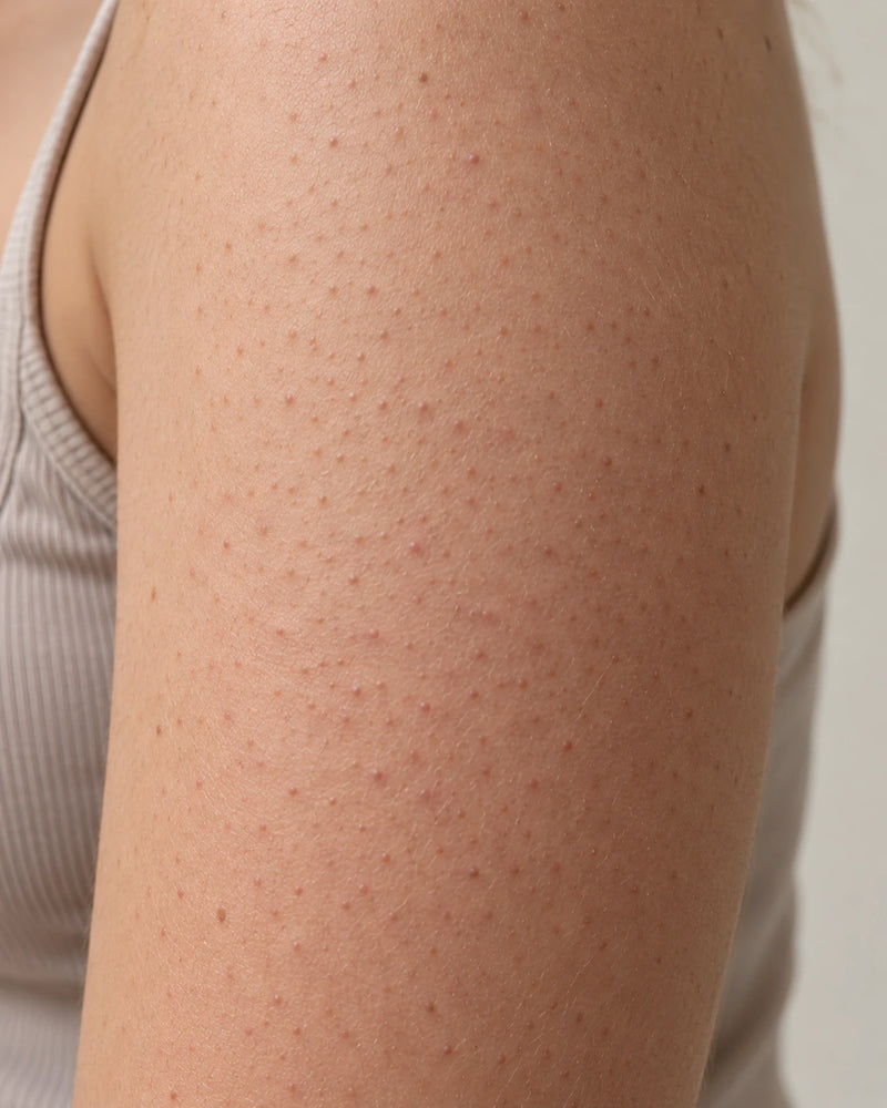 Before: close-up of an illustrative model's upper arm showing clusters of small rough follicular bumps typical of strawberry skin.