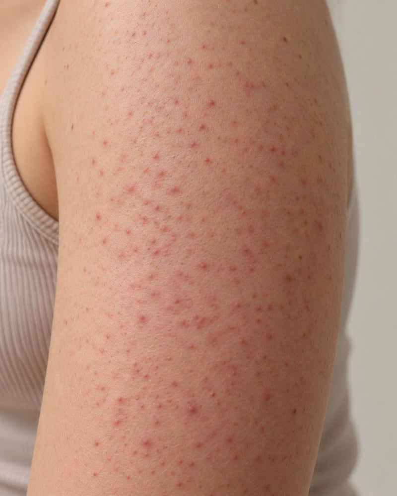 Before: close-up of an illustrative model's upper arm with visible rough bumps and naturally occurring redness around the follicles.