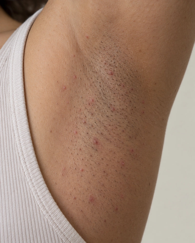 Before: close-up of an illustrative model's underarm showing natural stubble and small visible post-shave follicular bumps.