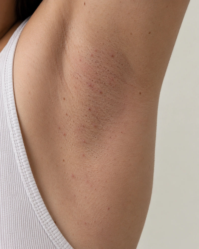 Before: close-up of an illustrative model's underarm showing mild post-shave redness, visible follicles and natural skin folds.