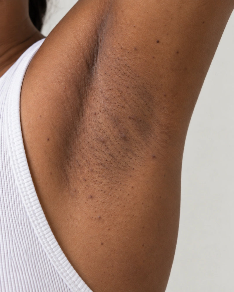 After 12 weeks: the same underarm with fewer raised bumps and more even-looking texture while natural pigmentation remains.
