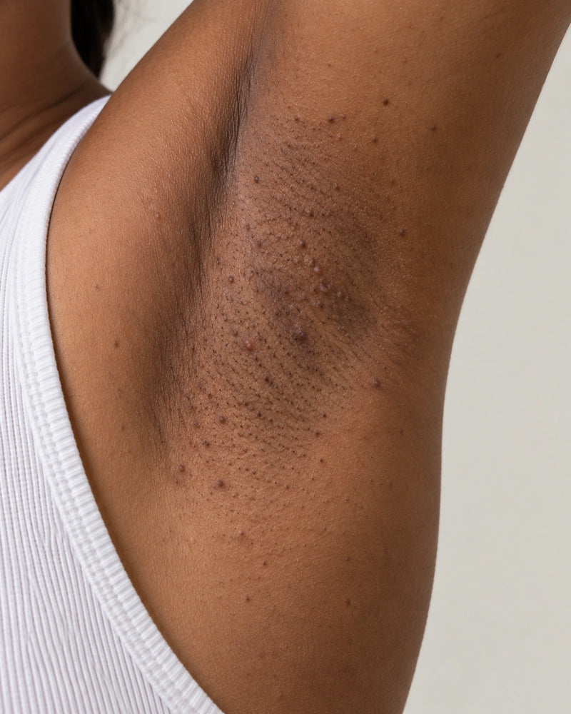 Before: close-up of an illustrative model's underarm showing visible follicular bumps, shaving-related marks and uneven texture.
