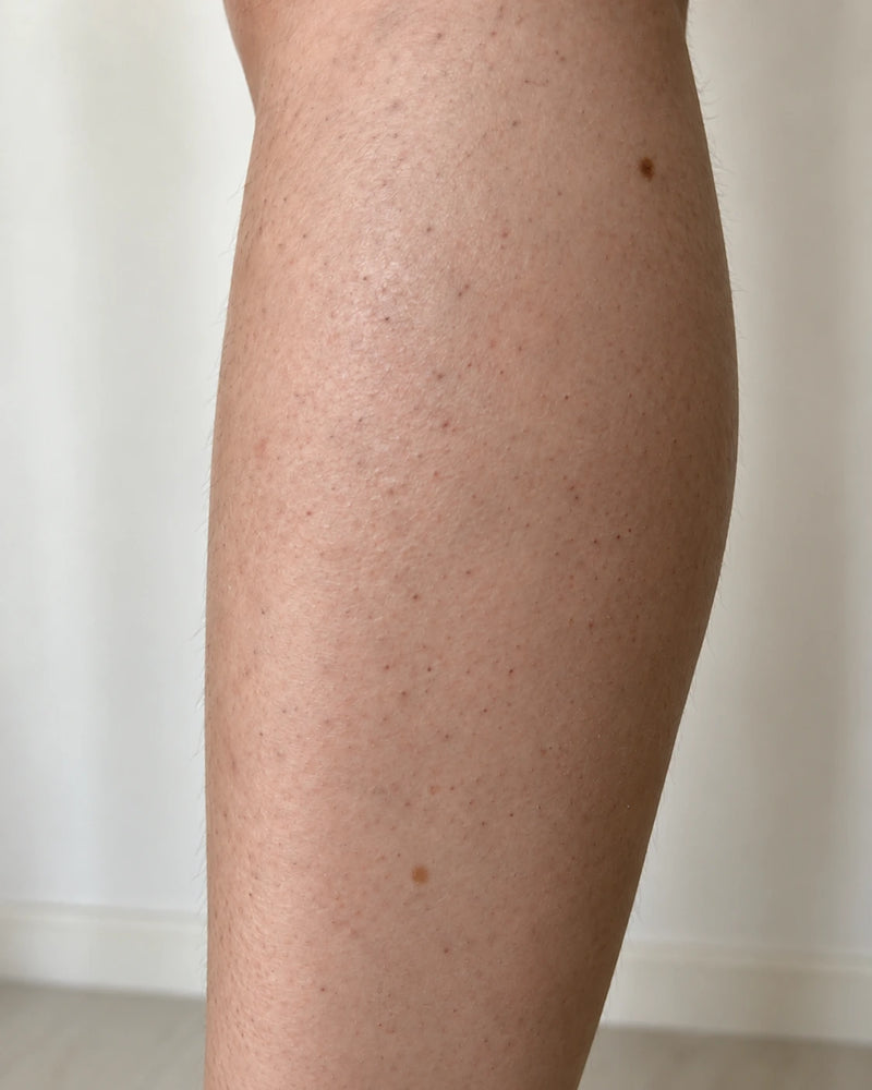 After 10 weeks: the same lower leg with smoother-looking texture and less visiblefollicular dots, with natural pores and skin variation preserved.