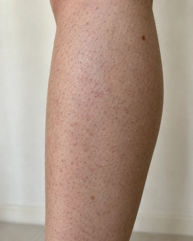 Before:close-up of an illustrative model's lower leg showing visible follicular dots,mild roughness and uneven strawberry skin texture.