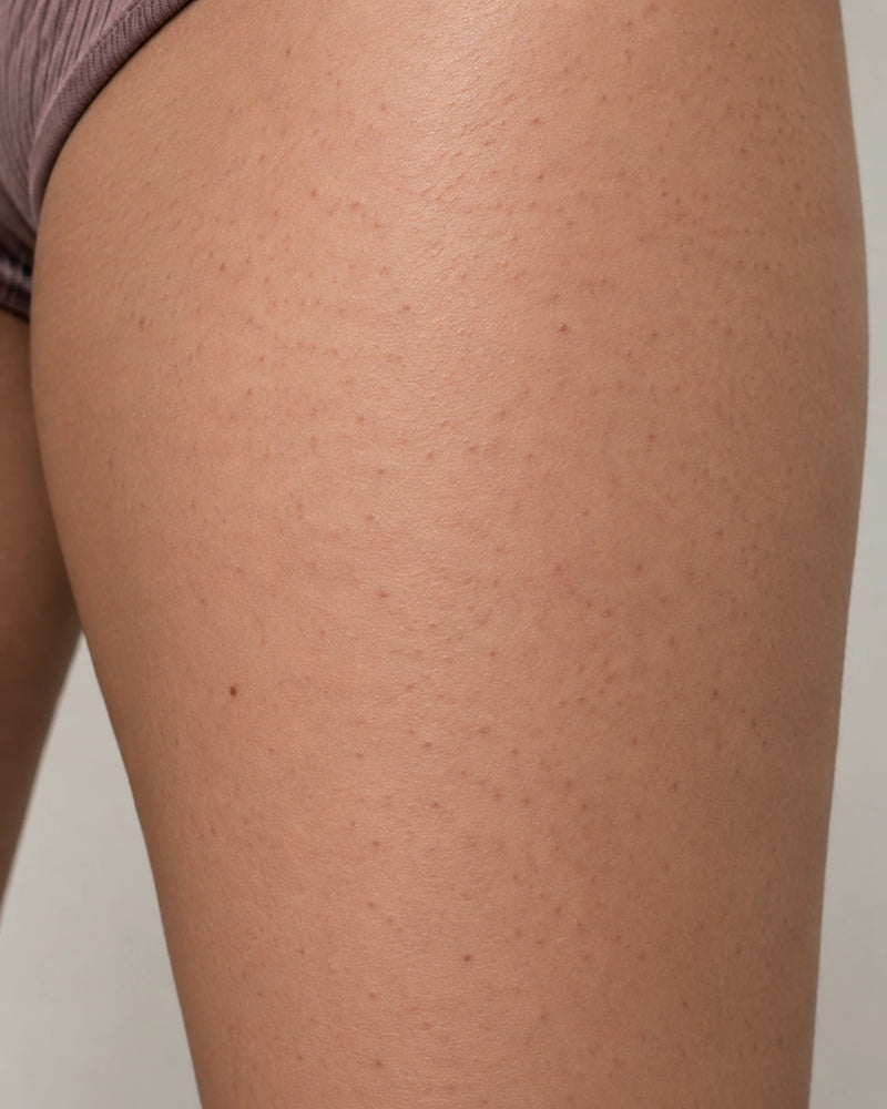 After 8 weeks: the same thigh showing visibly softer and smoother-looking skin whileretaining natural pores, hair and minor bumps.