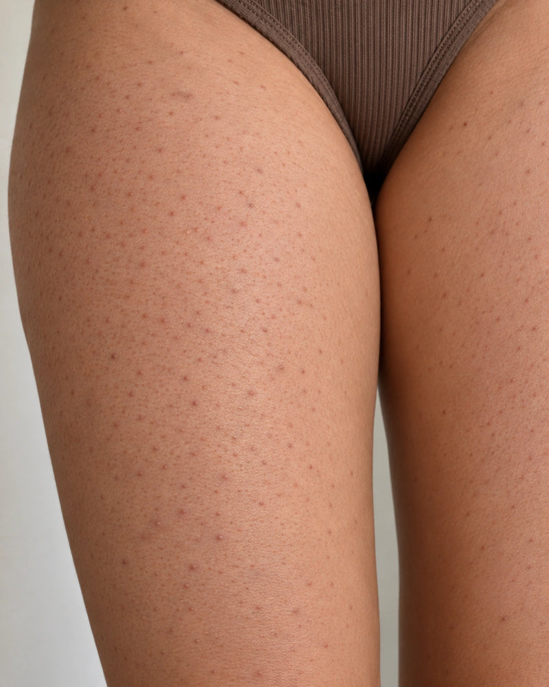 Before: close-up of an adult illustrative model's outer thigh showing rough follicular bumps, mild dryness and scattered reddish-brown marks.