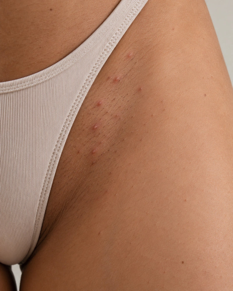 Before: close-up of an adult illustrative model's outer bikini line showing natural stubble and several visible post-shave follicular bumps.