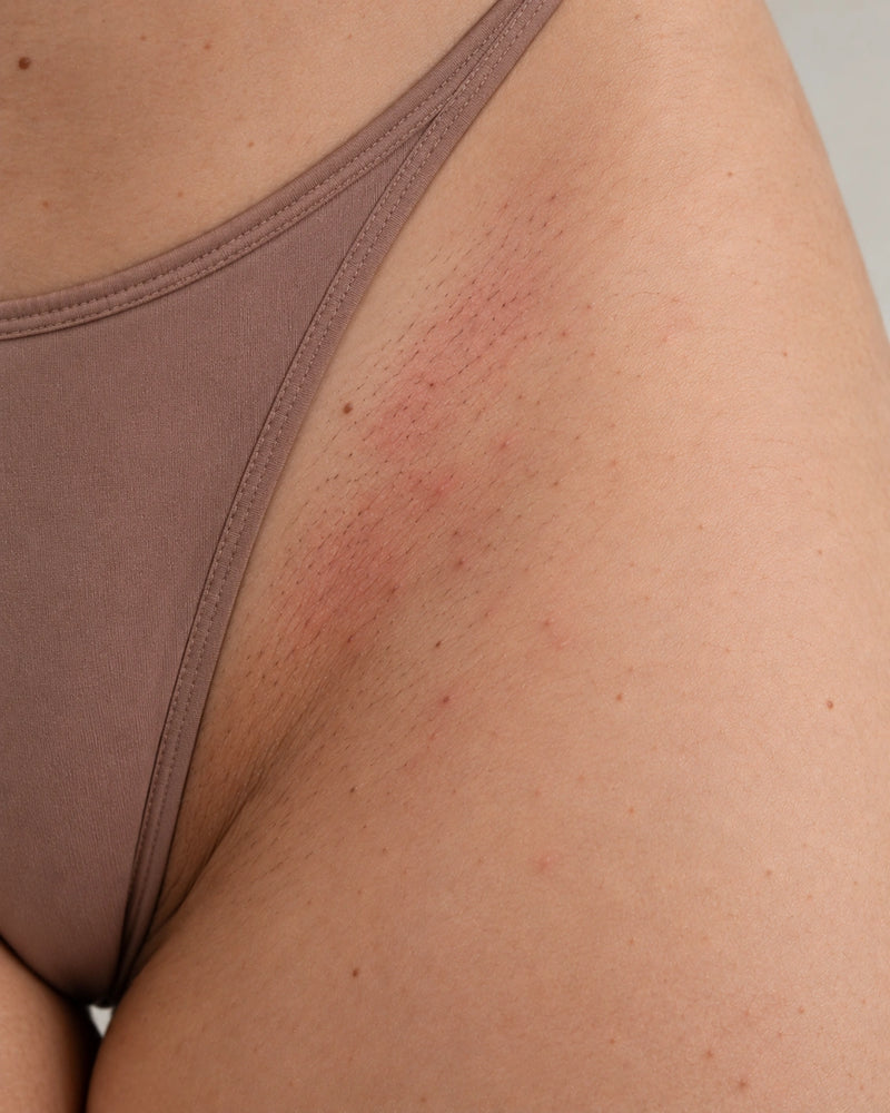 Before: close-up of an adult illustrative model's outer bikini line showing mild post-hair-removal redness and visible follicles.